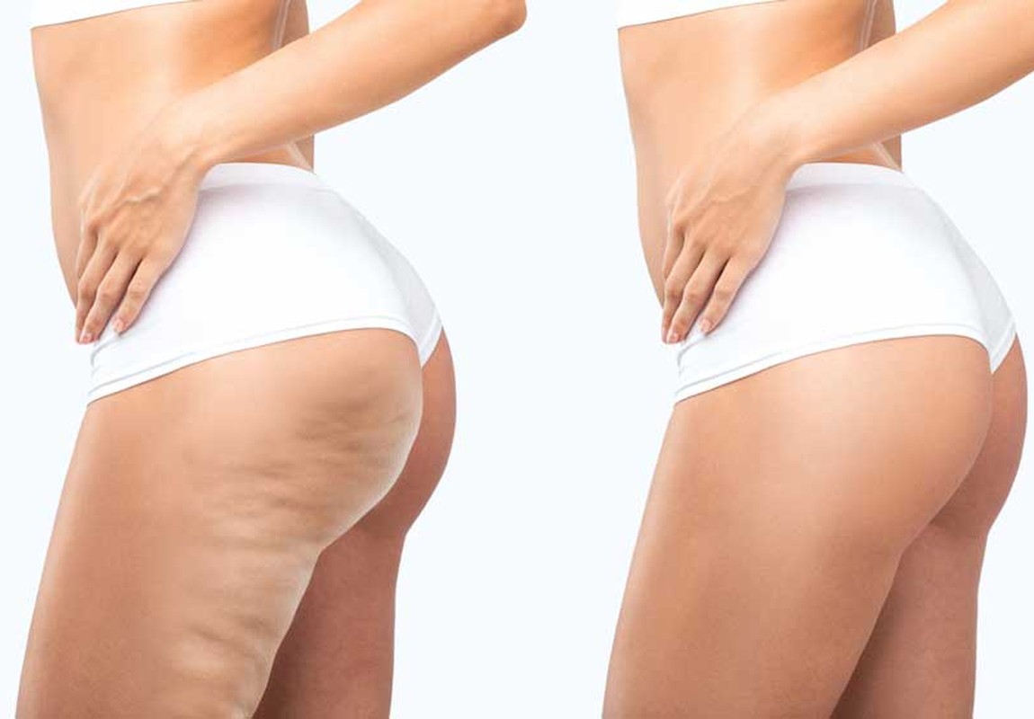 Illustration of cellulite dimpling on the left and smooth skin on the right. Illustrative image, not a patient of this practice.