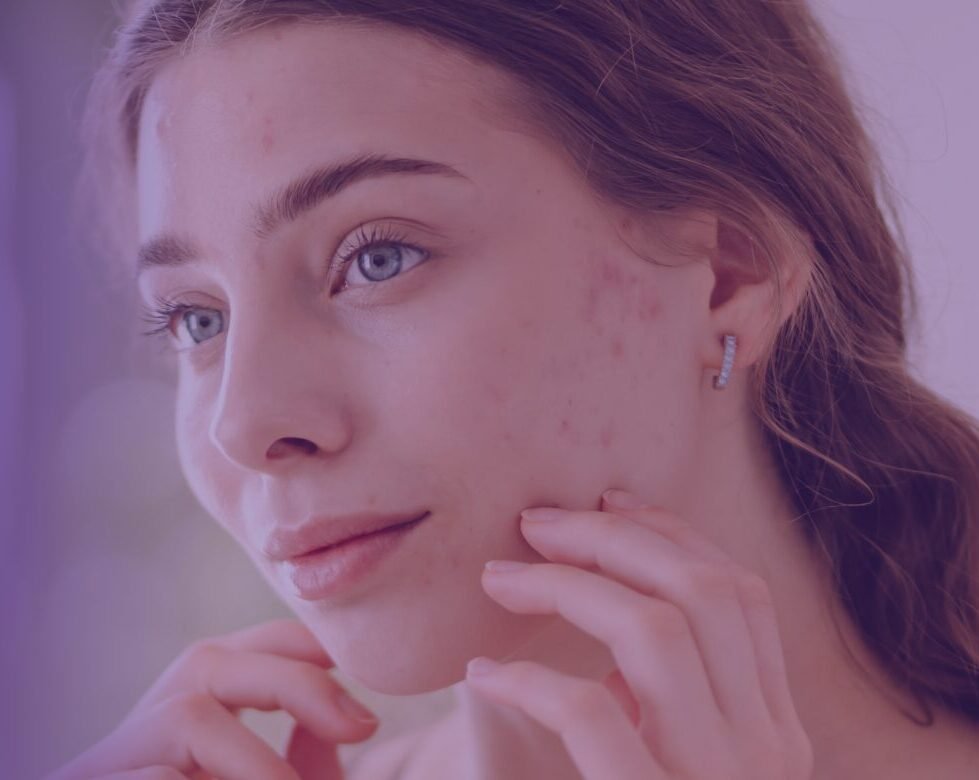Acne scar treatment at Natural Results in Scottsdale, AZ