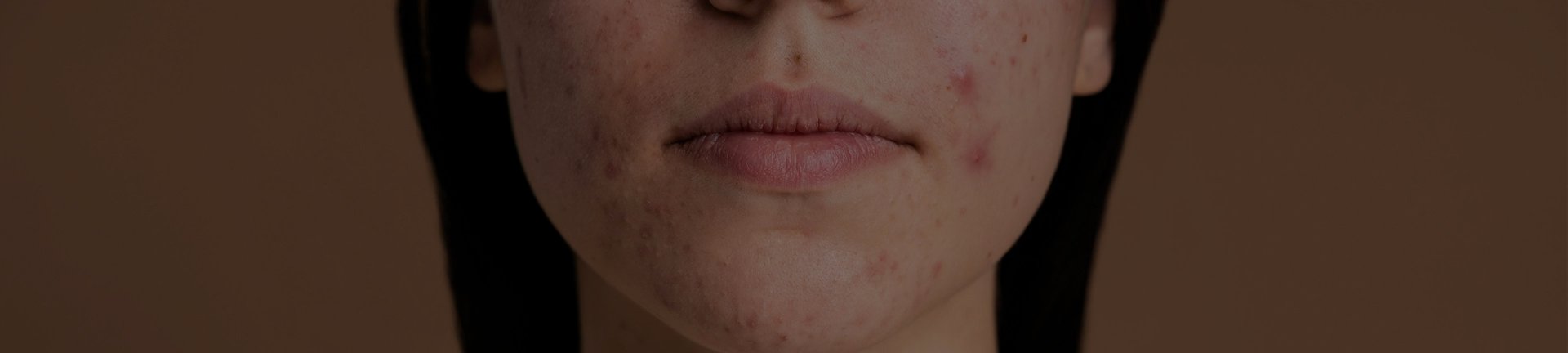 AVAVA laser treatment at Natural Results in Scottsdale, AZ