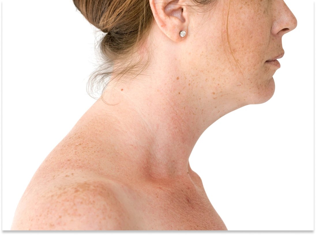 Buffalo Hump Removal at Natural Results in Scottsdale, AZ