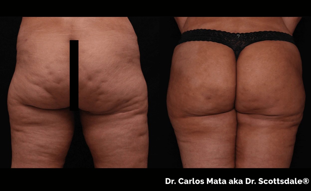Cellfina by Dr. Carlos Mata in Scottsdale, AZ