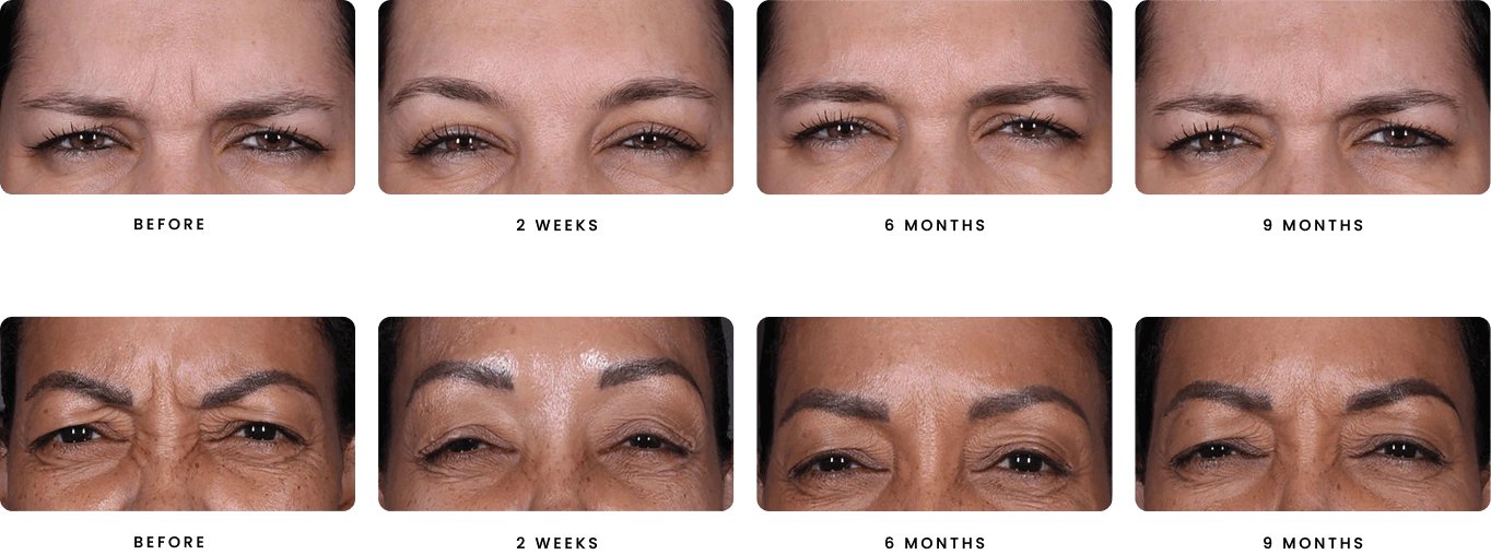 Daxxify treatment at Natural Results in Scottsdale, AZ