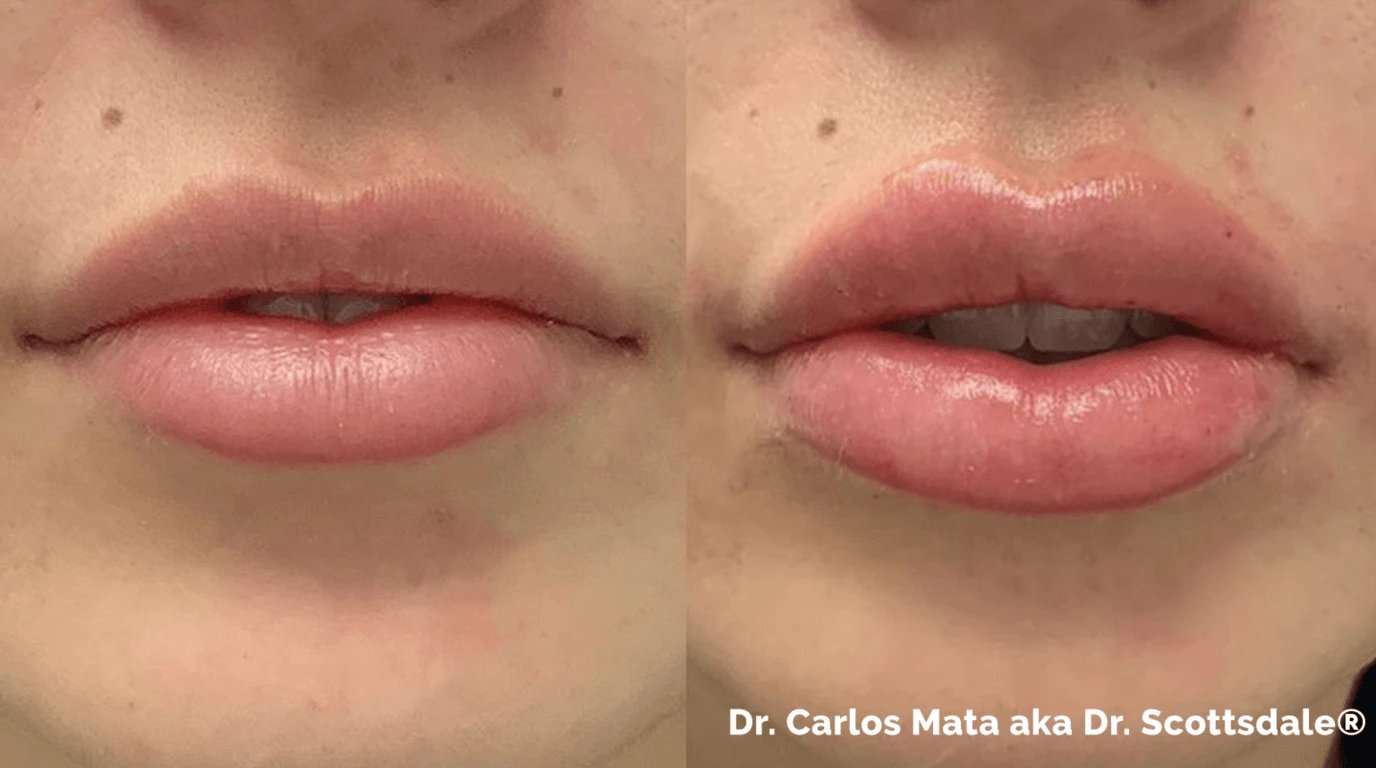 Lip fillers at Natural Results in Scottsdale, AZ