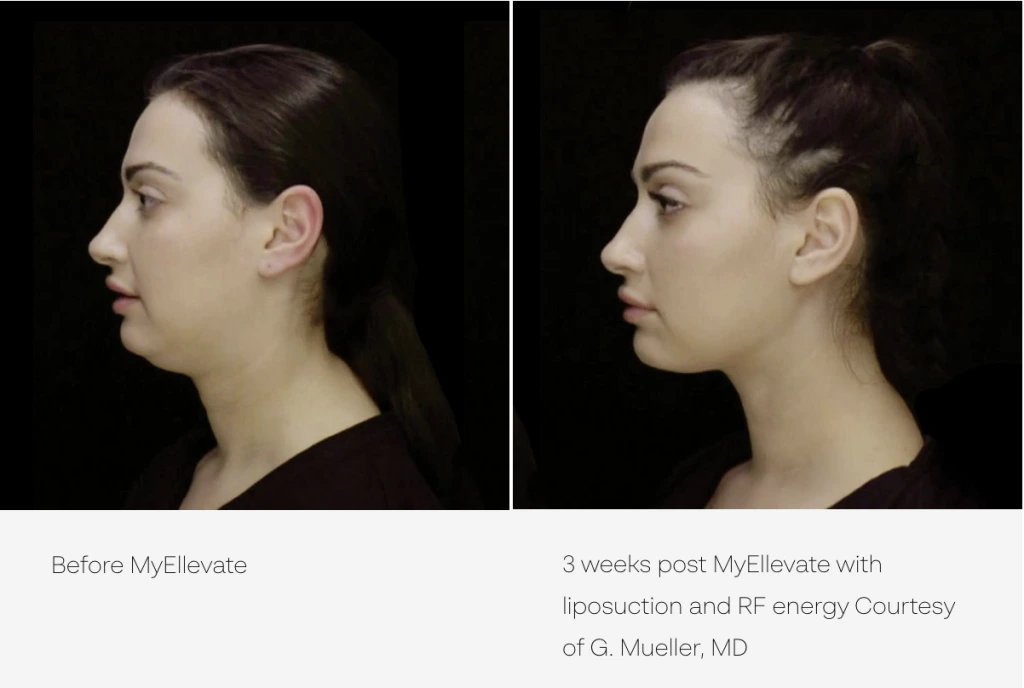 MyEllevate® at Natural Results in Scottsdale, AZ