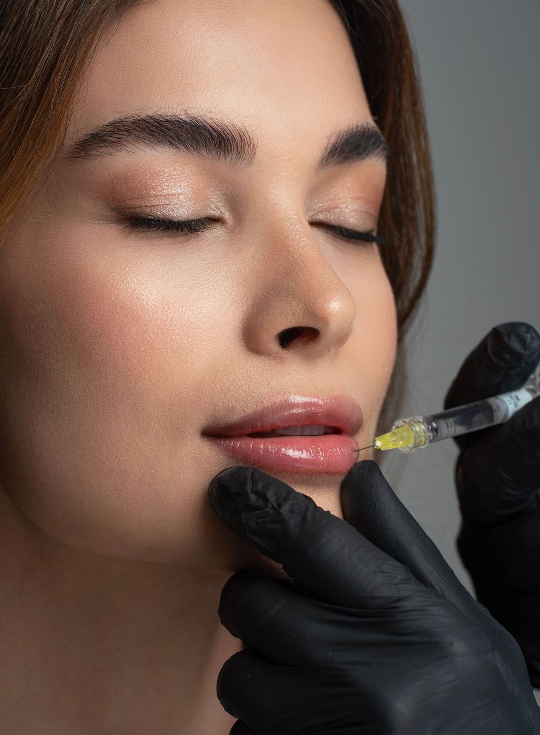 A gloved injector placing lip filler along the lower lip