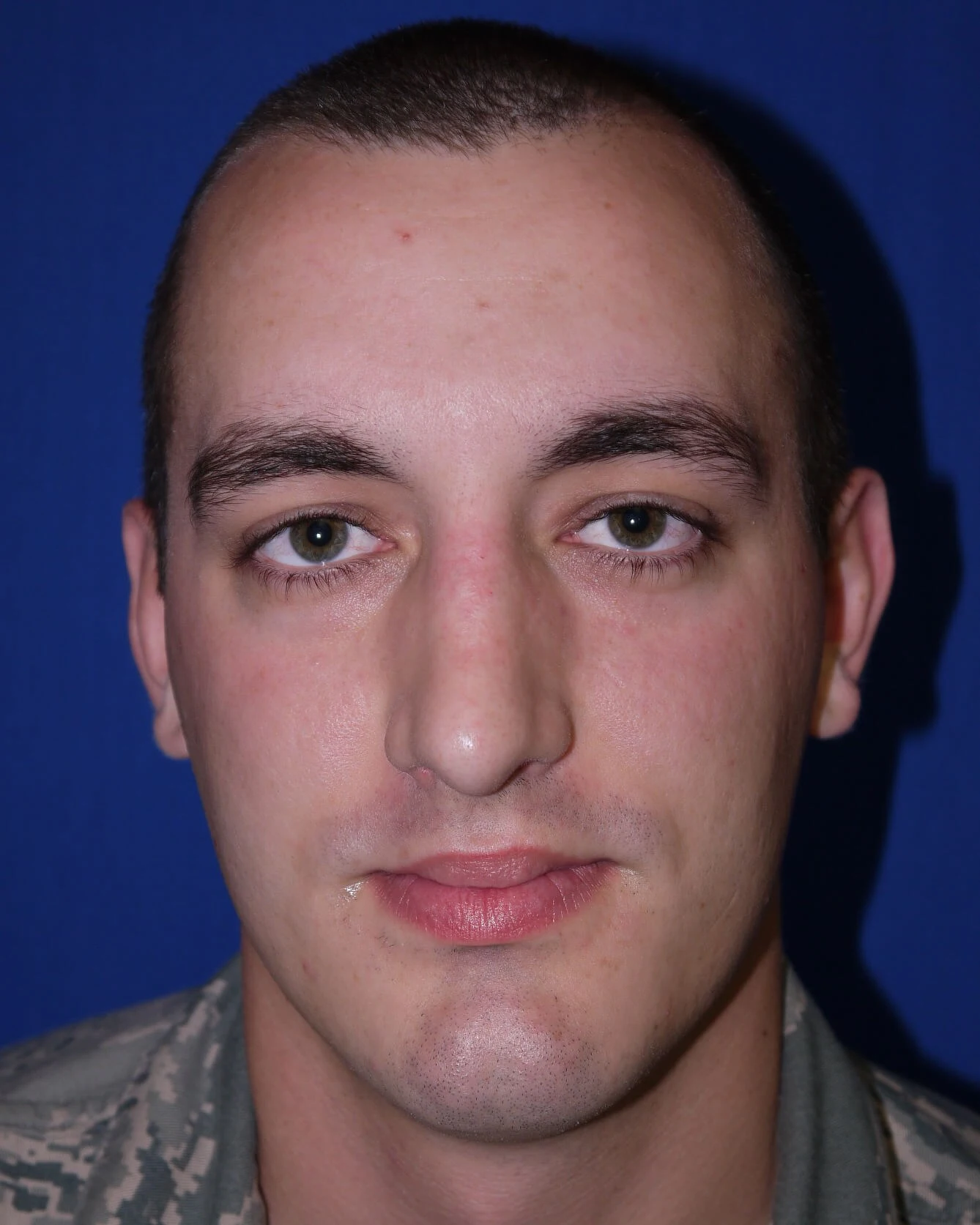 Case #17406 after front