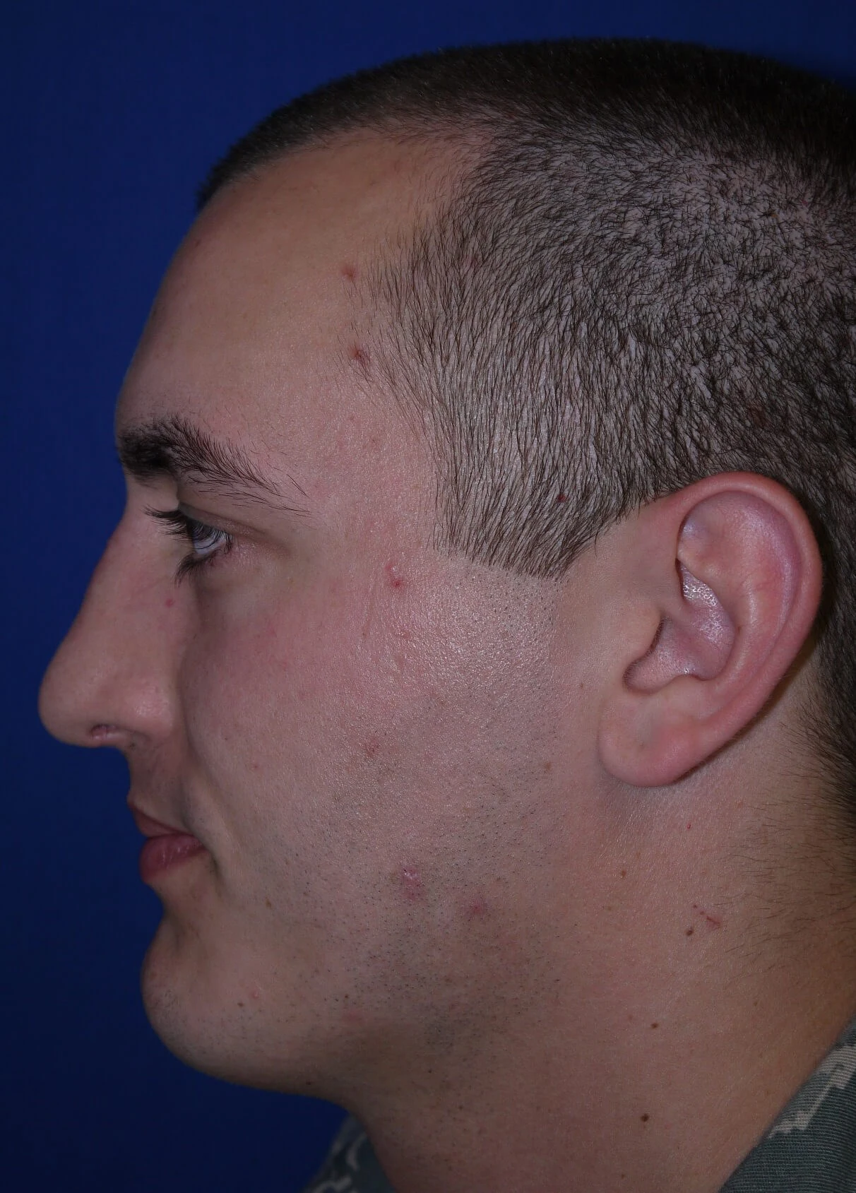 Case #17406 after lateral