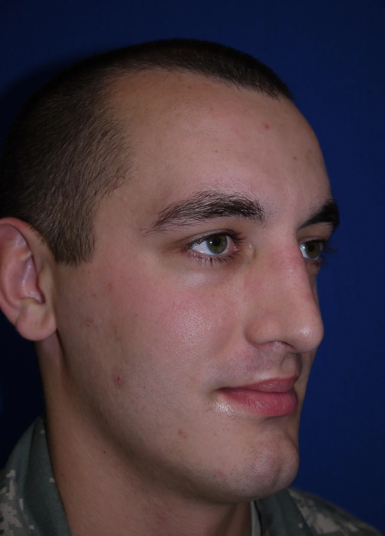 Case #17406 after right lateral