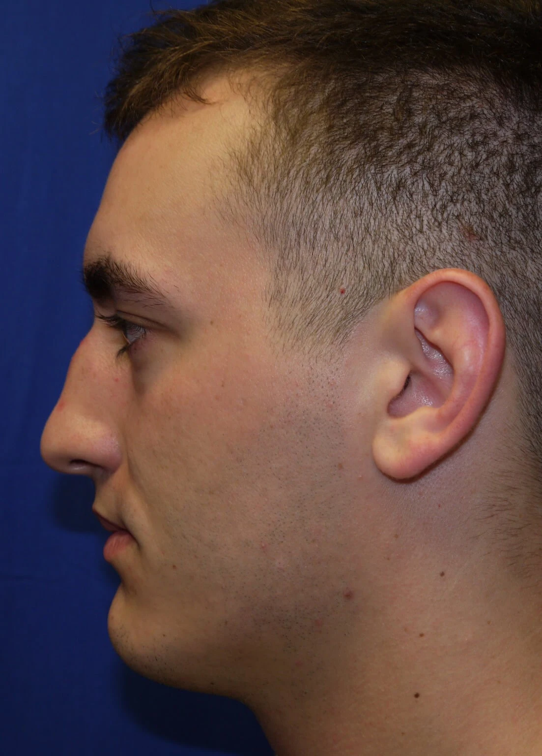 Case #17406 before lateral