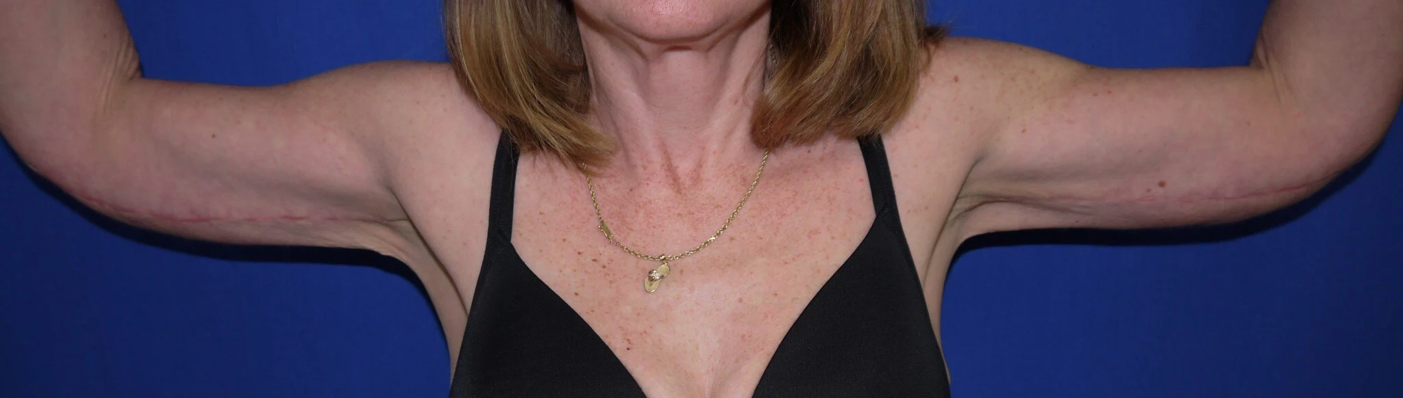 Case #17452 After front