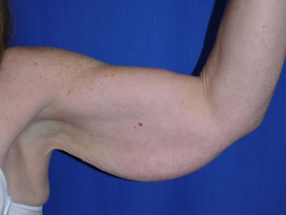 Case #17452 Before left