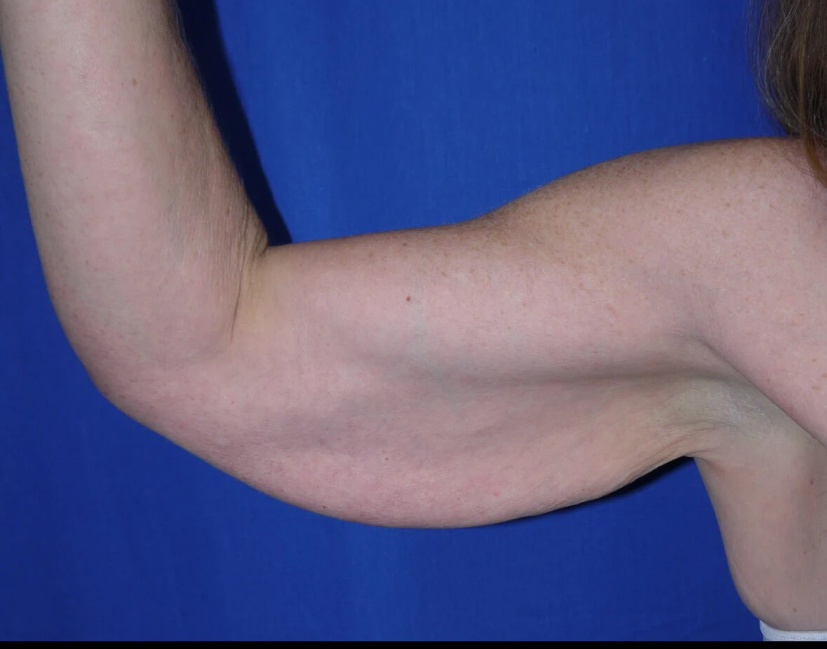 Case #17452 before right