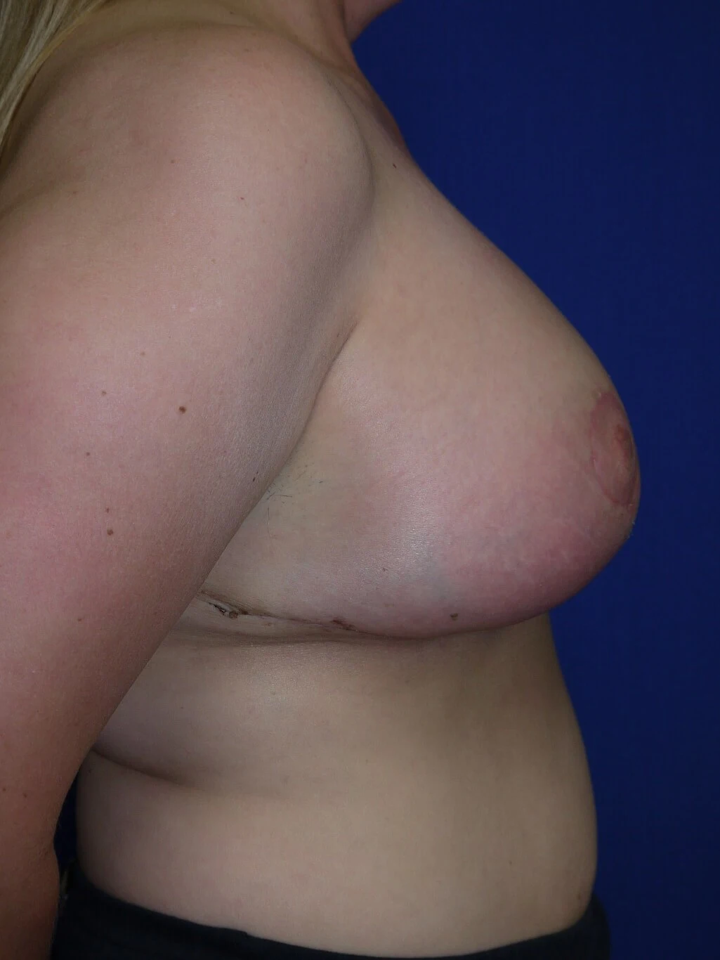 Case #17609 After right side