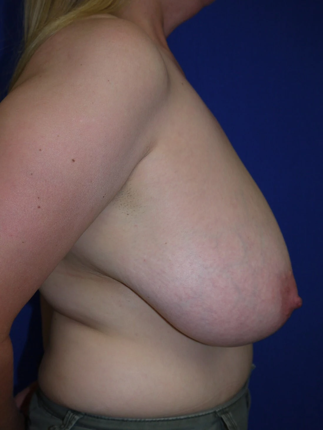 Case #17609 before right side