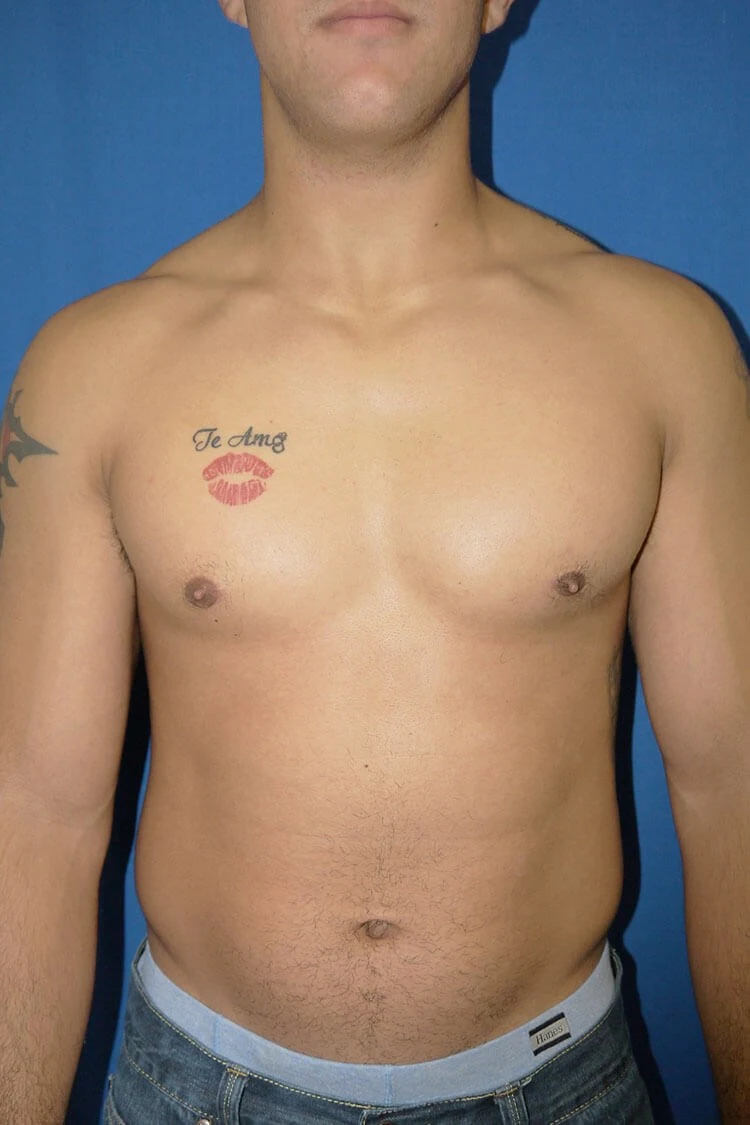 Case #17651 after front