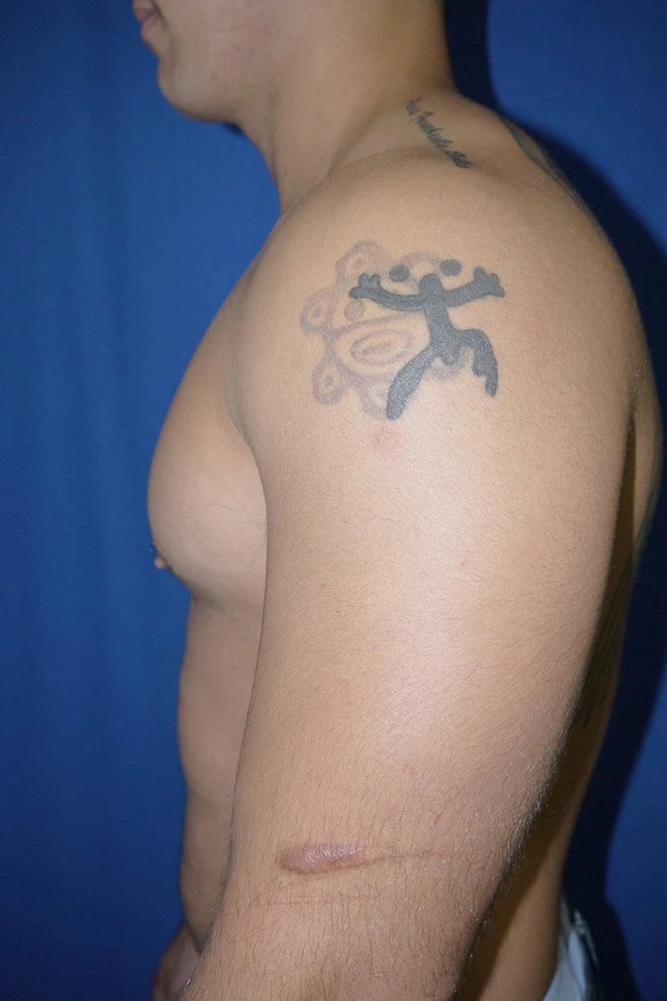 Case #17651 after left side