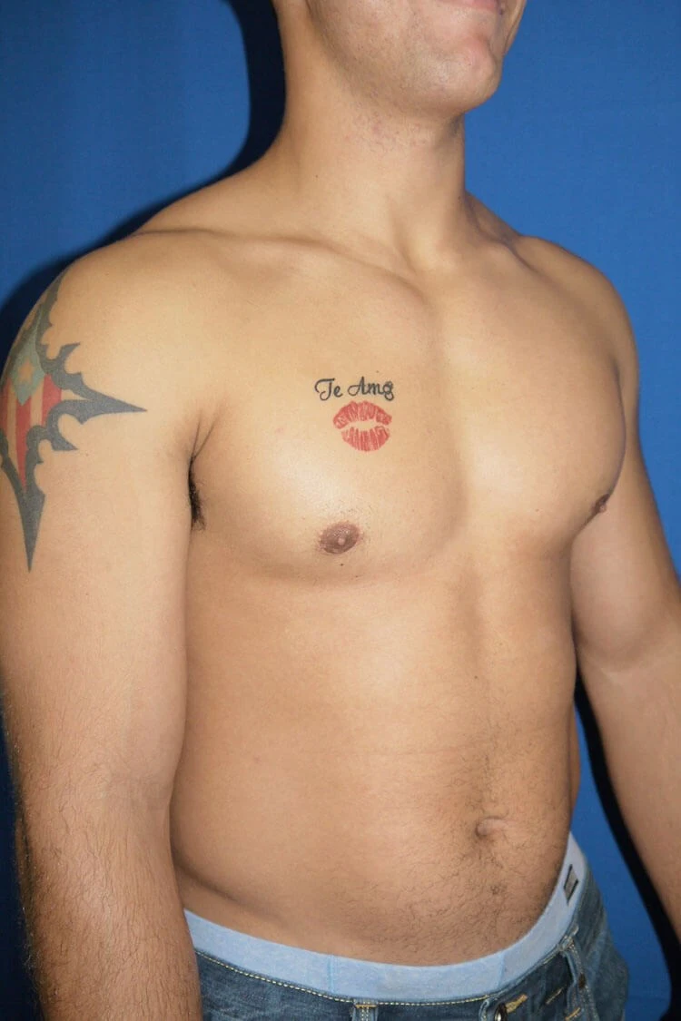 Case #17651 after right oblique