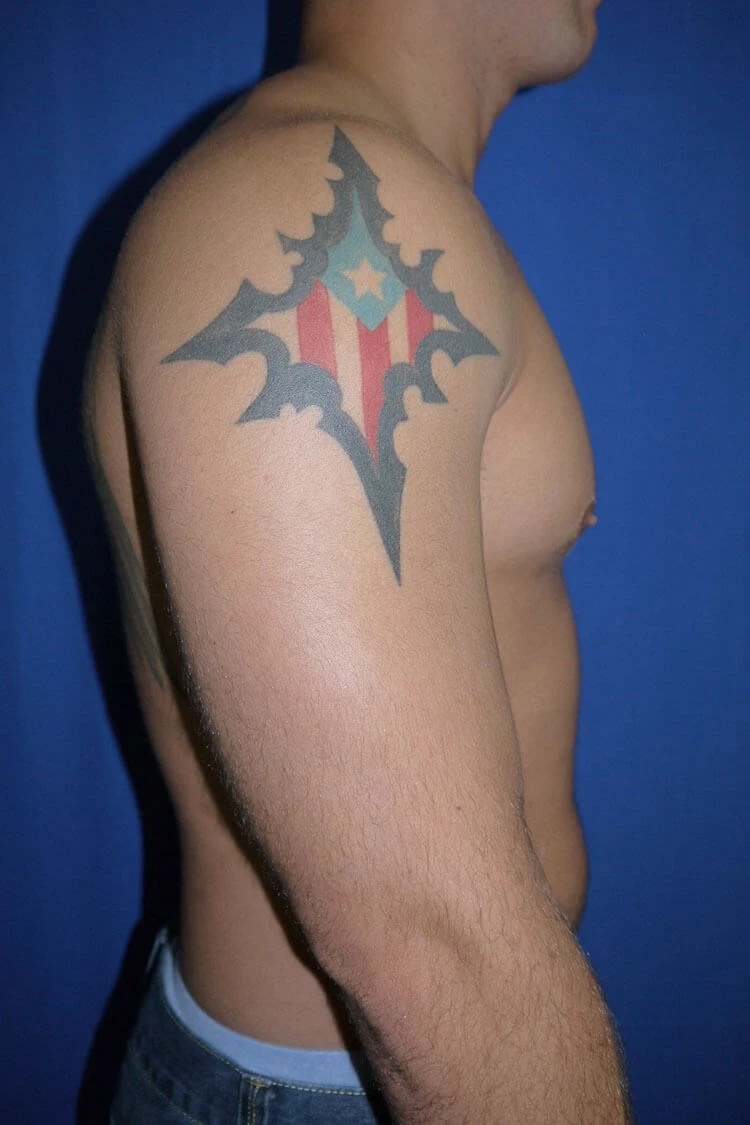 Case #17651 after right