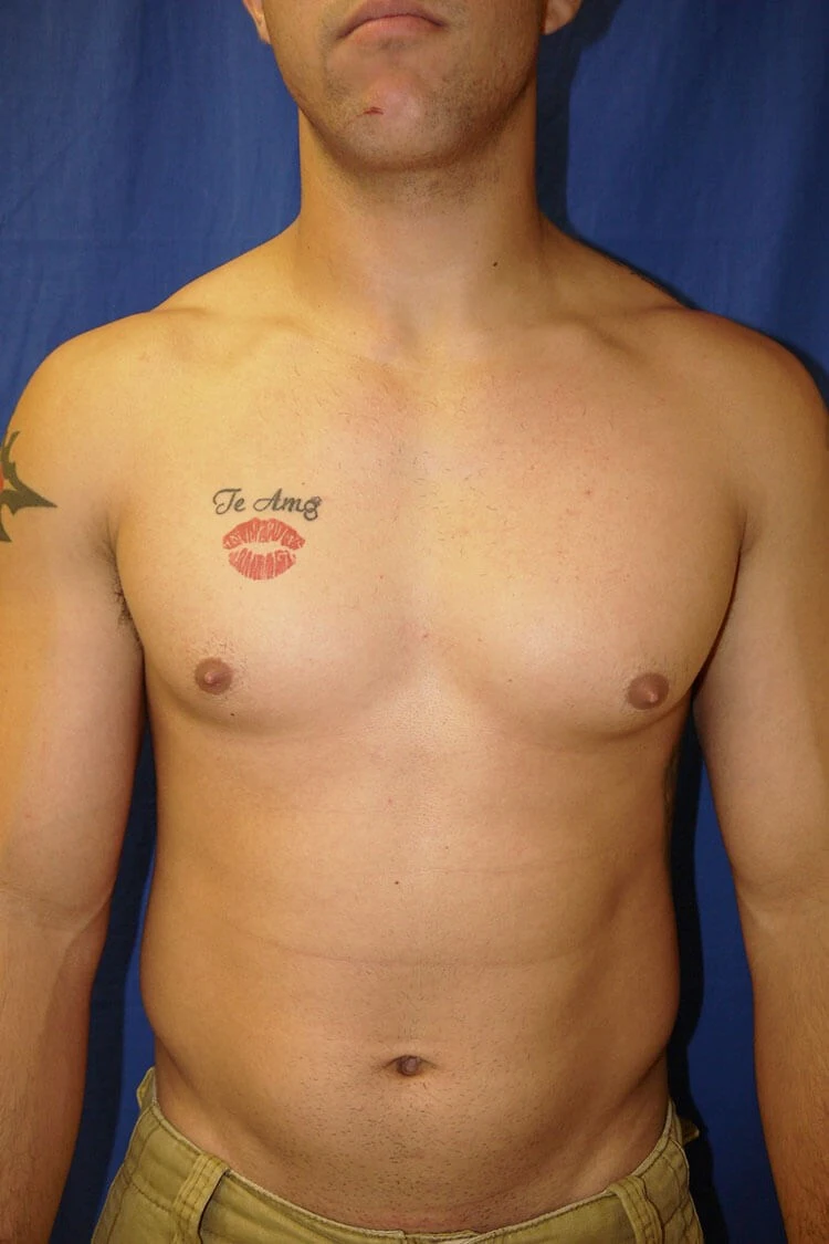 Case #17651 before front