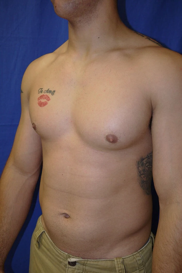 Case #17651 before left oblique