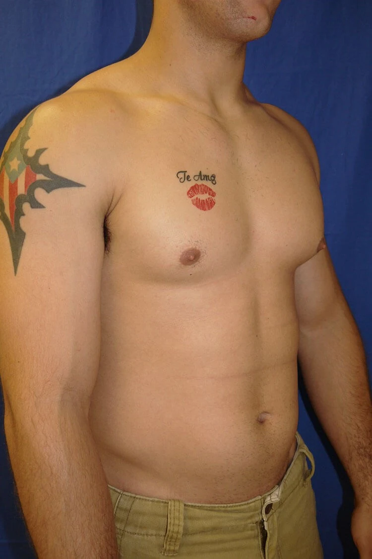 Case #17651 before right oblique