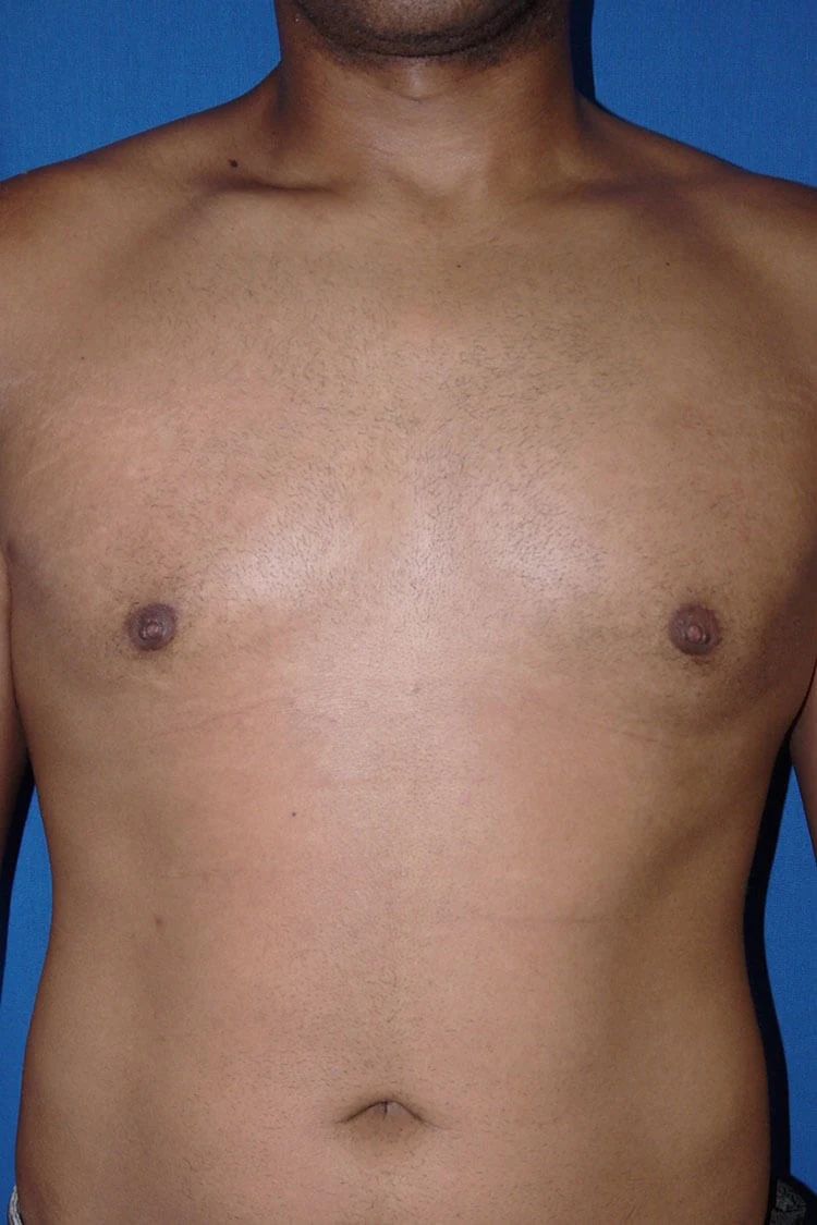 Case #17652 after front