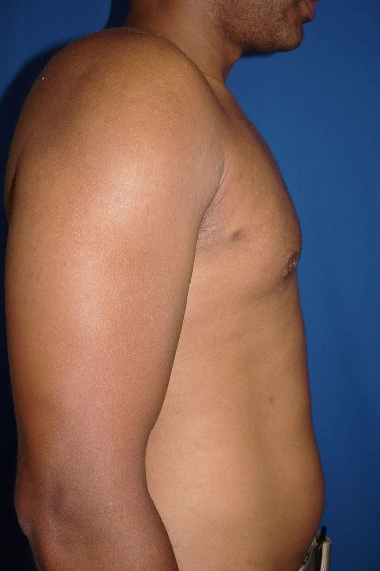 Case #17652 after right side