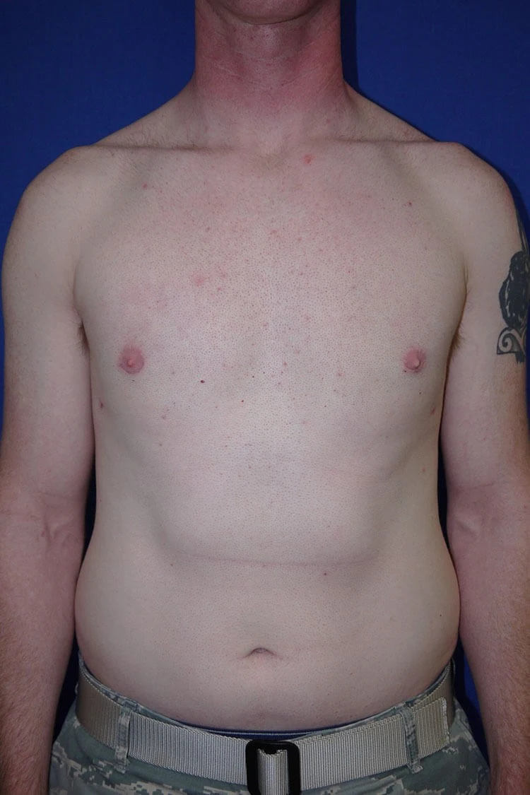 Case #17653 after front