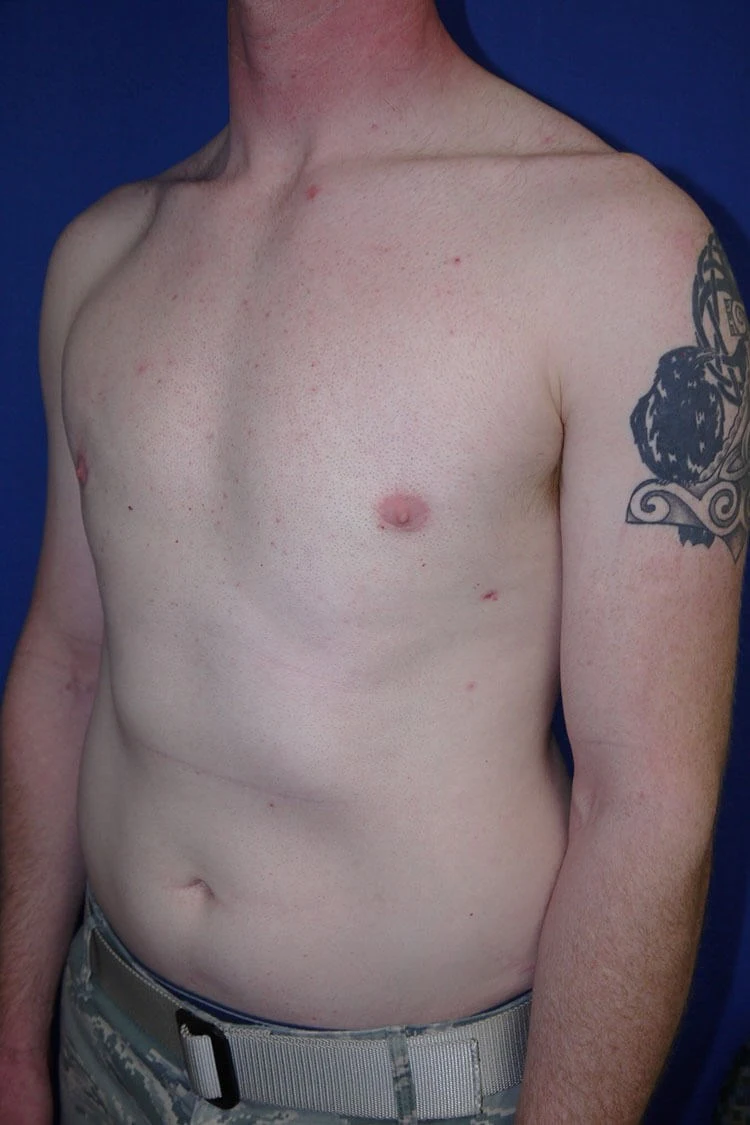 Case #17653 after left oblique