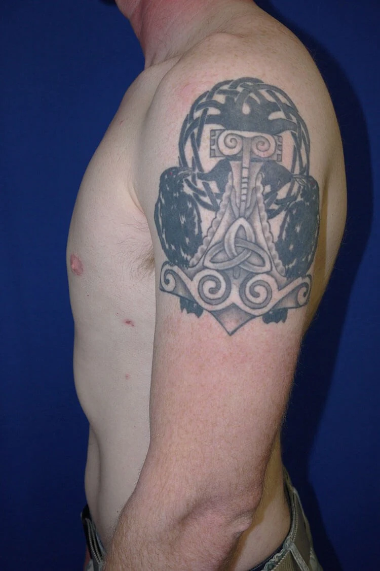 Case #17653 after left side