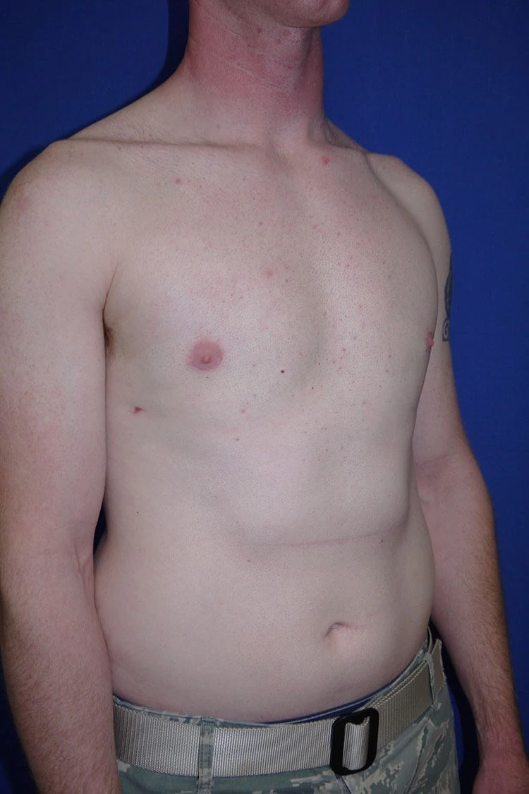 Case #17653 after right oblique