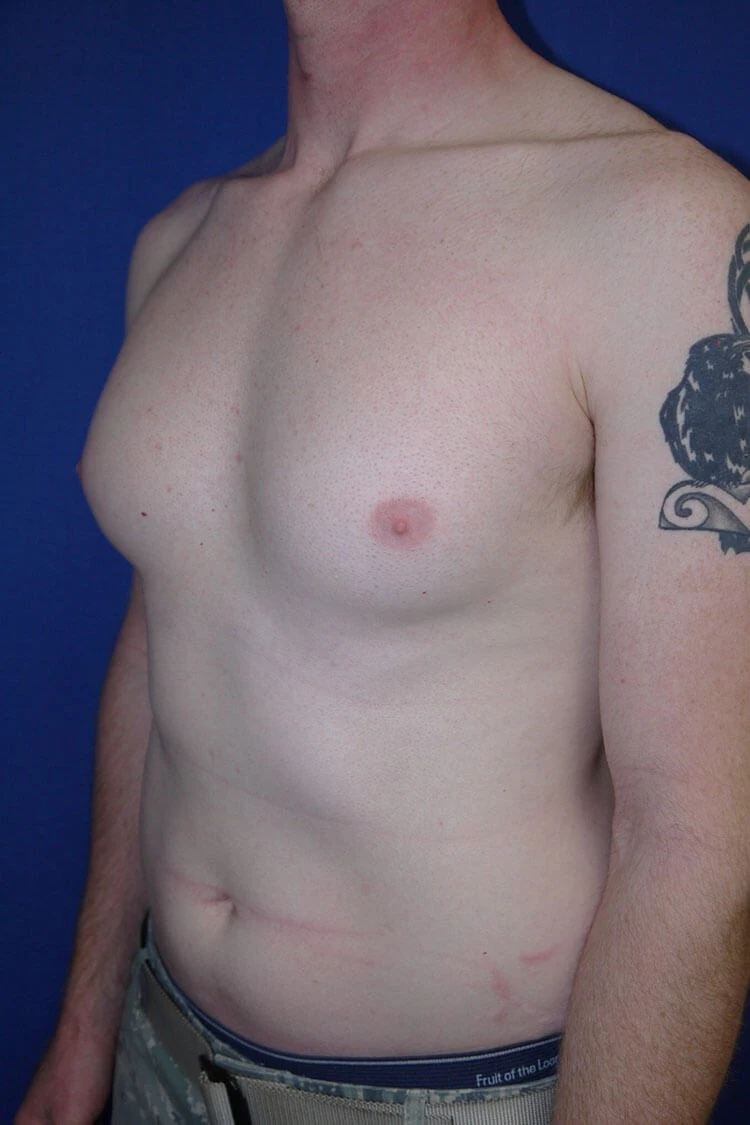 Case #17653 before left oblique