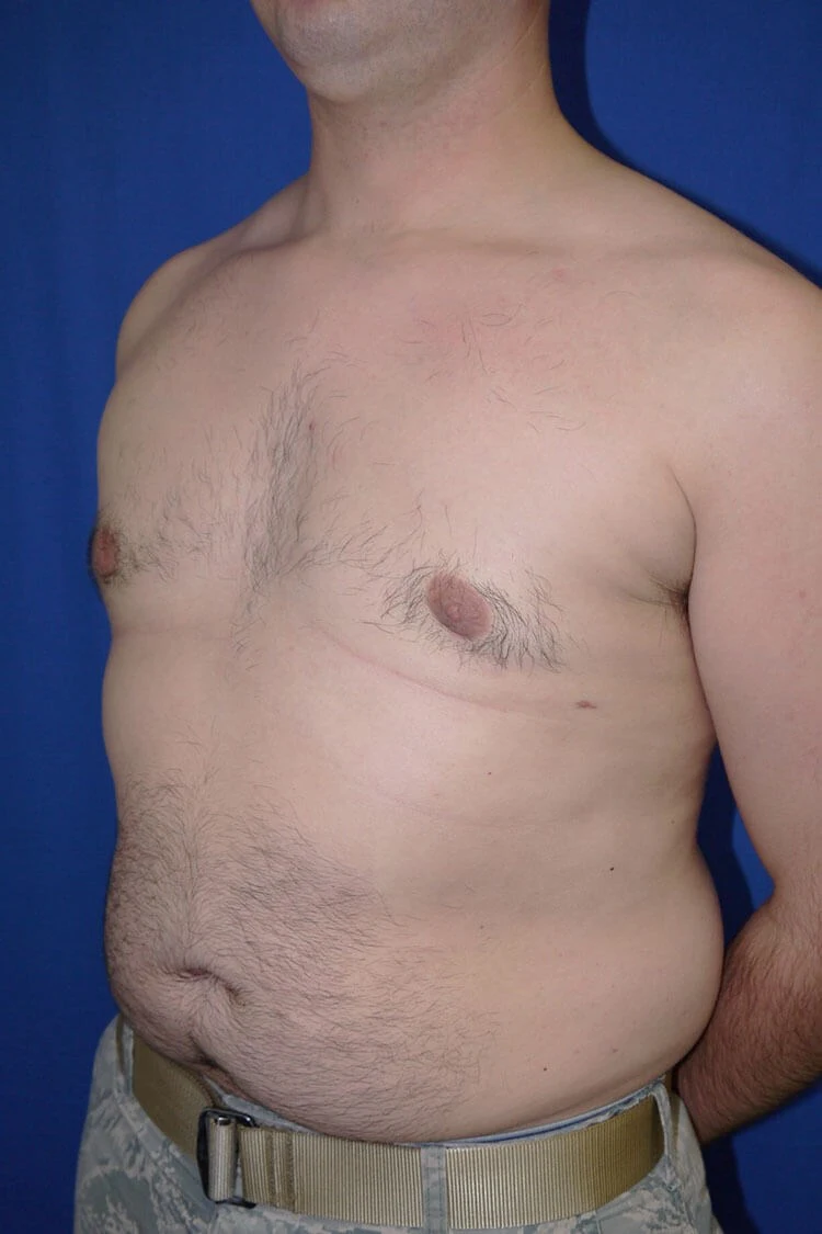 Case #17656 after left oblique