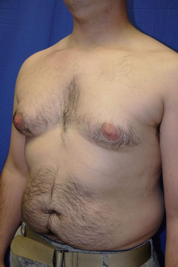 Case #17656 before left oblique