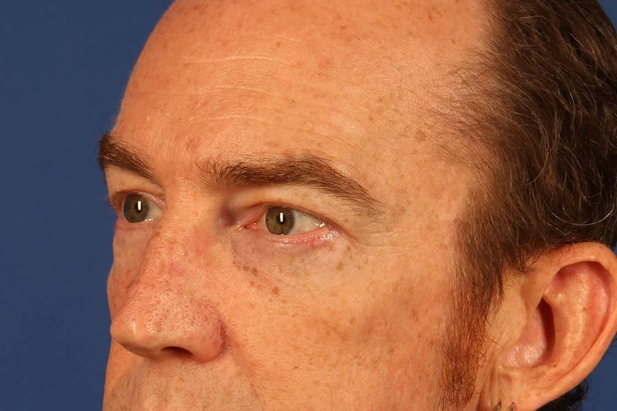 Case #17660 after left oblique