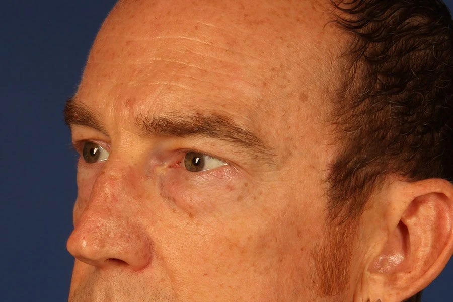 Case #17660 before left oblique