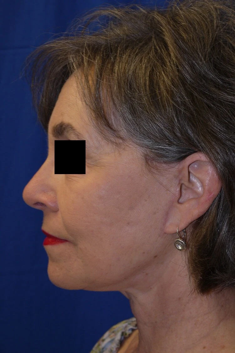 Case #17672 after left side