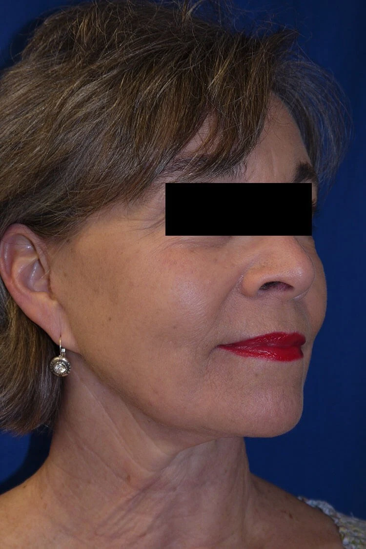 Case #17672 after right oblique