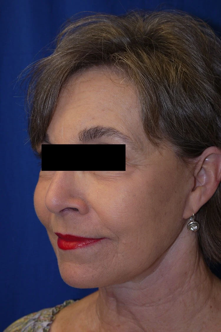 Case #17672 after right side