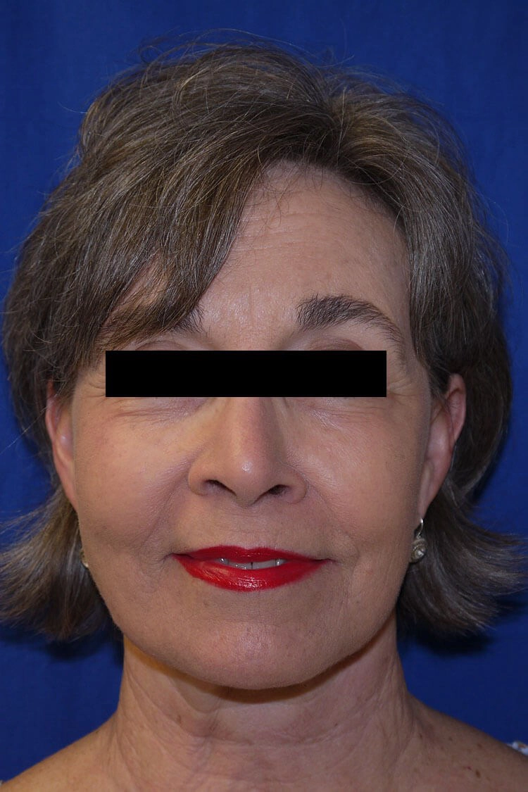 Case #17672 after_opt