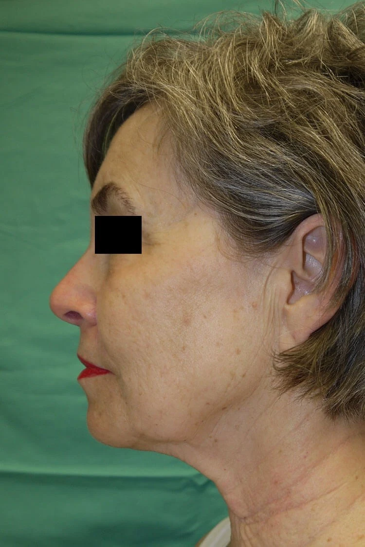 Case #17672 before left side