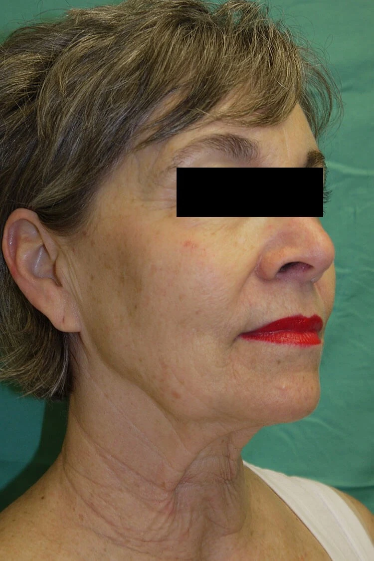 Case #17672 before right oblique