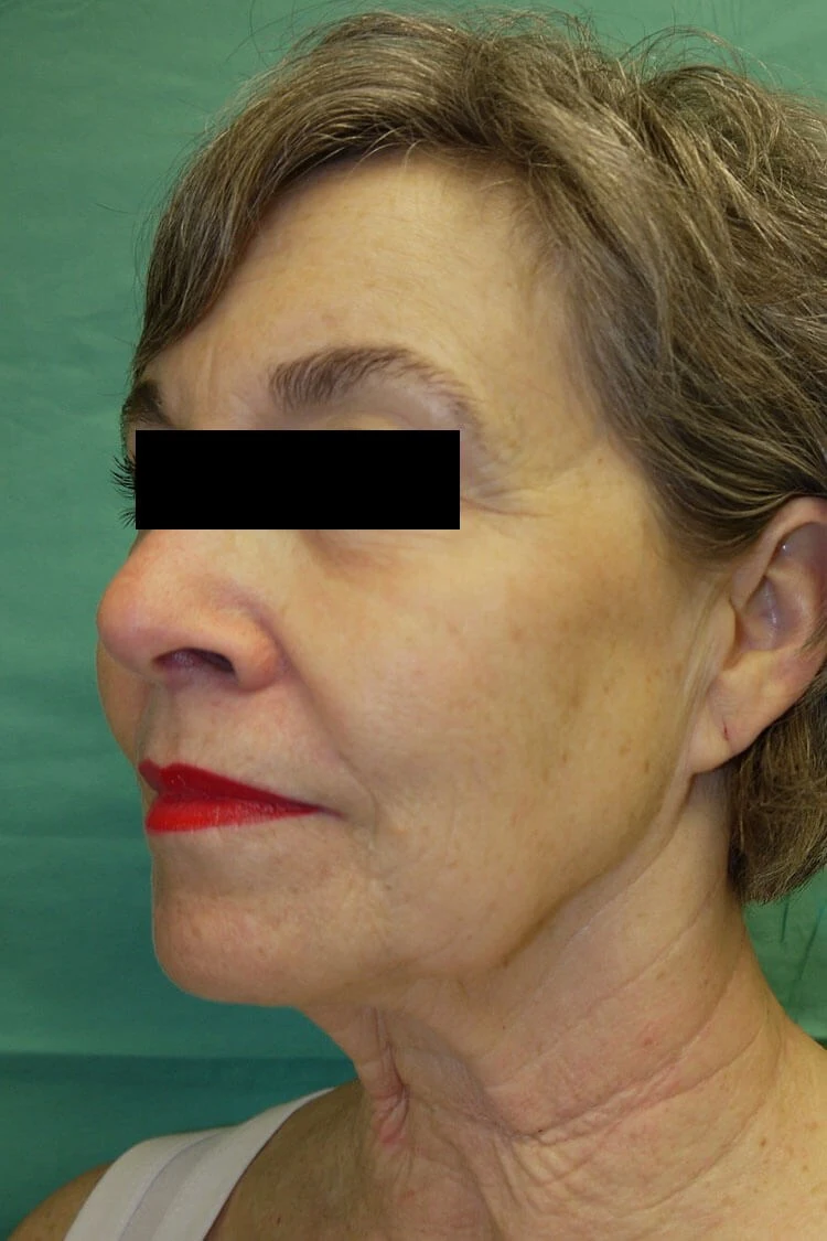 Case #17672 before right side