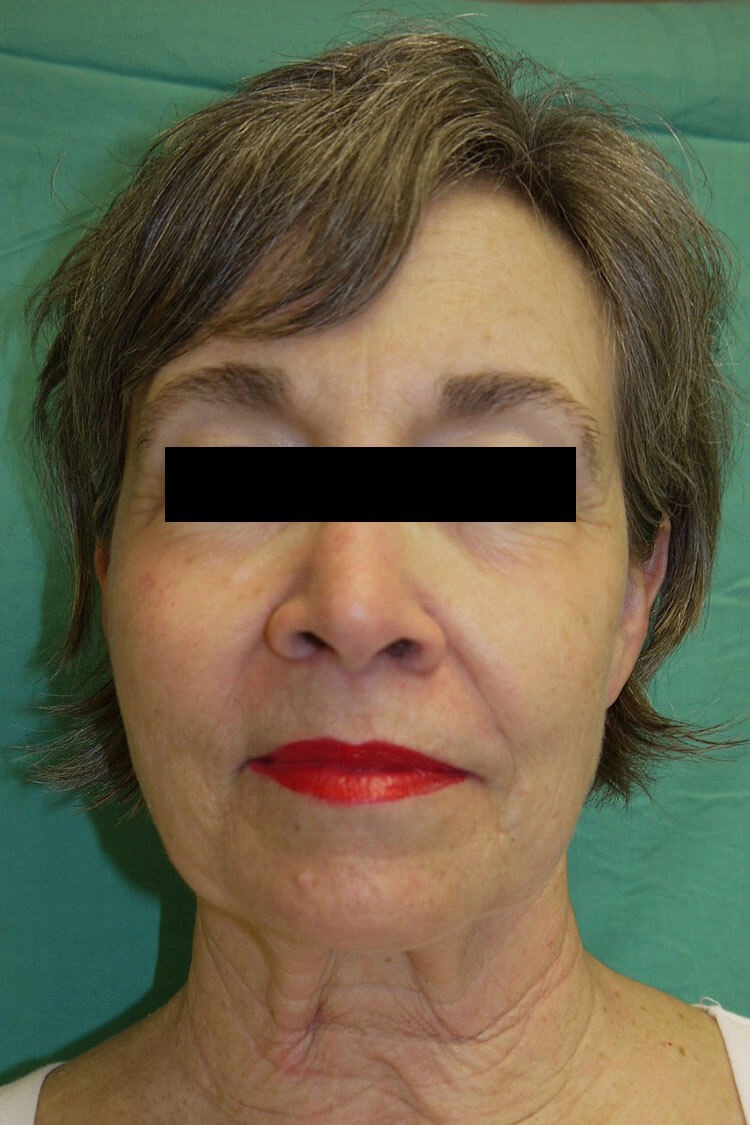 Case #17672 before_opt