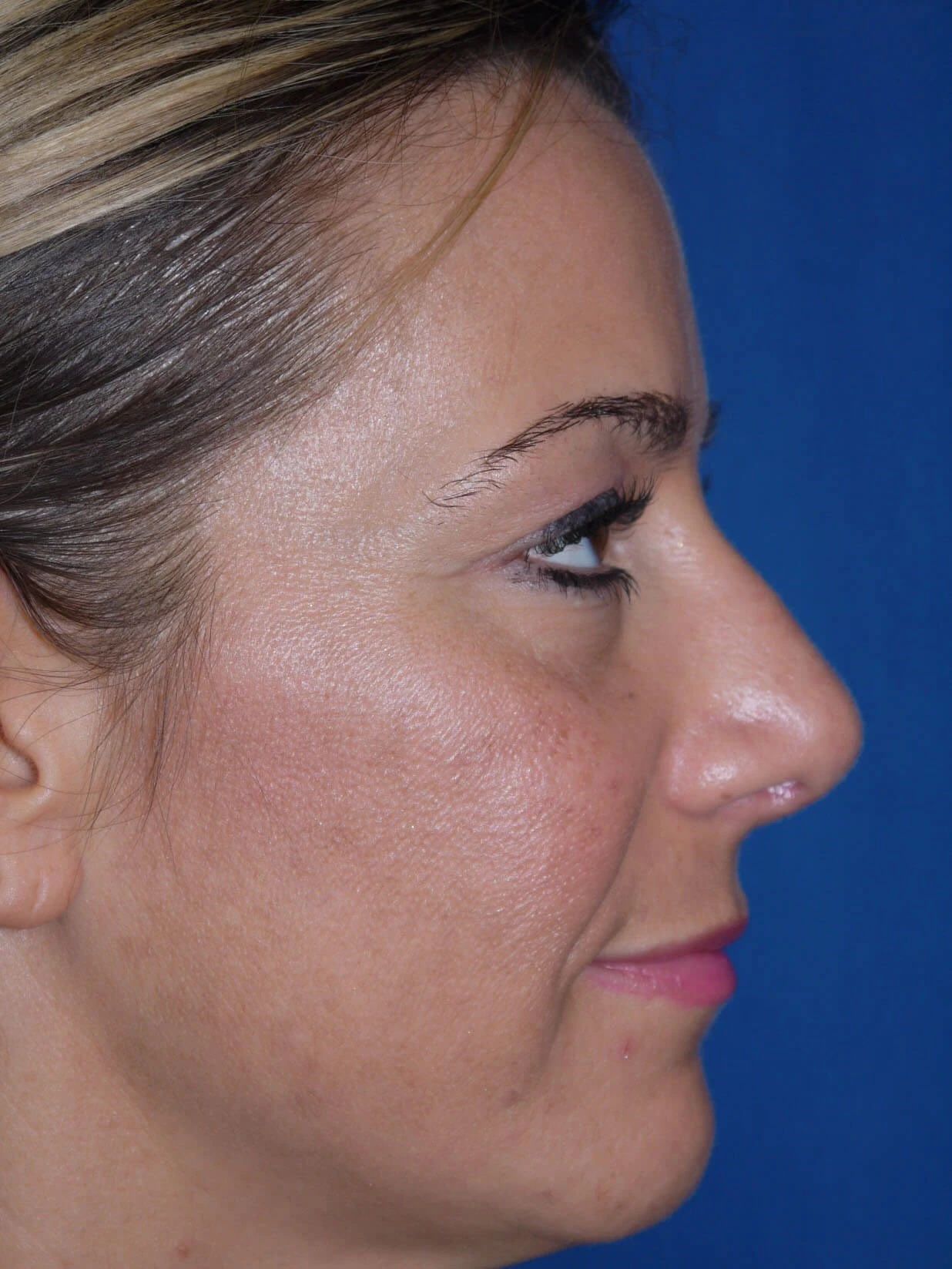 Case #18618 After right side