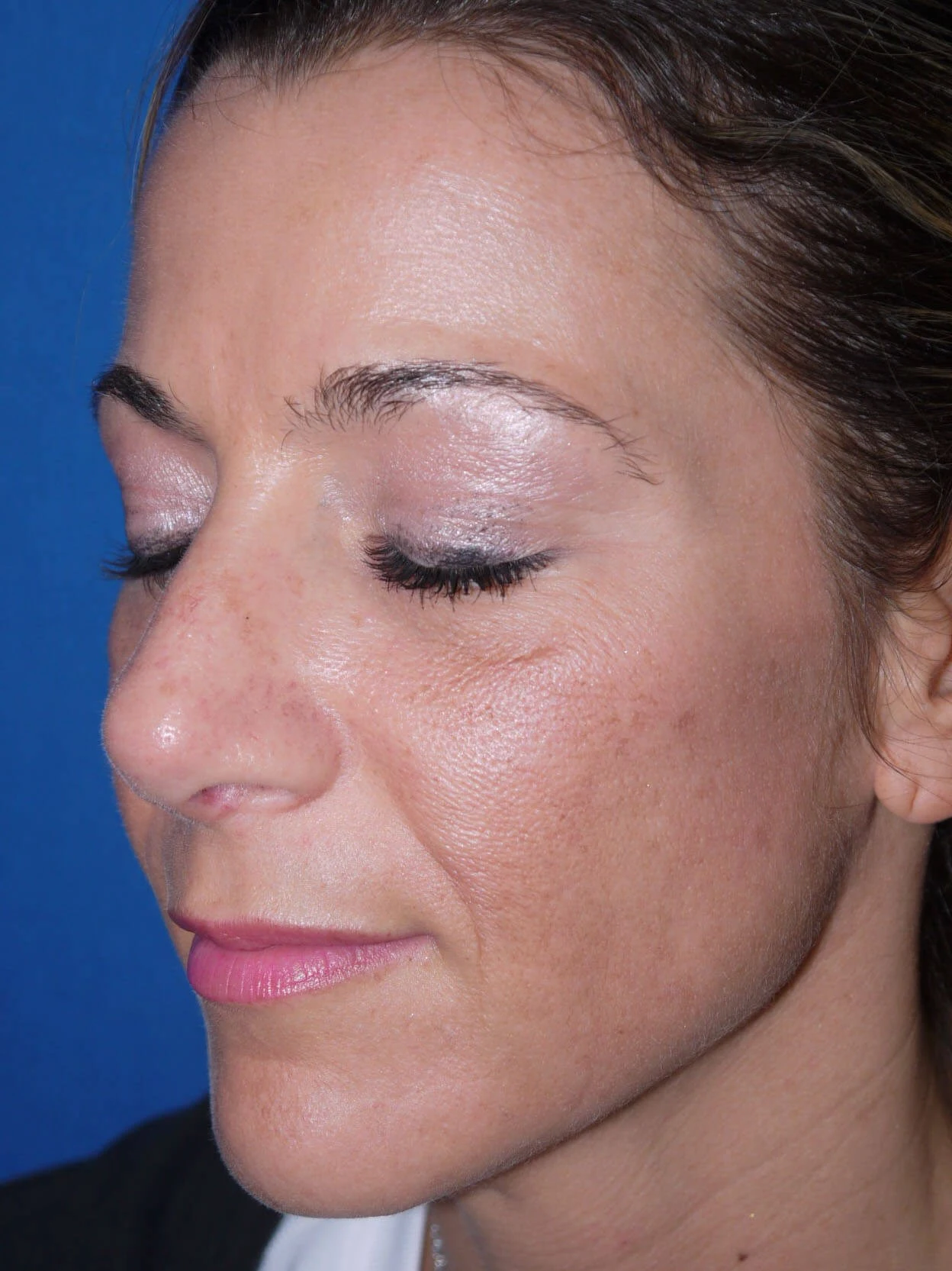 Case #18618 after left oblique