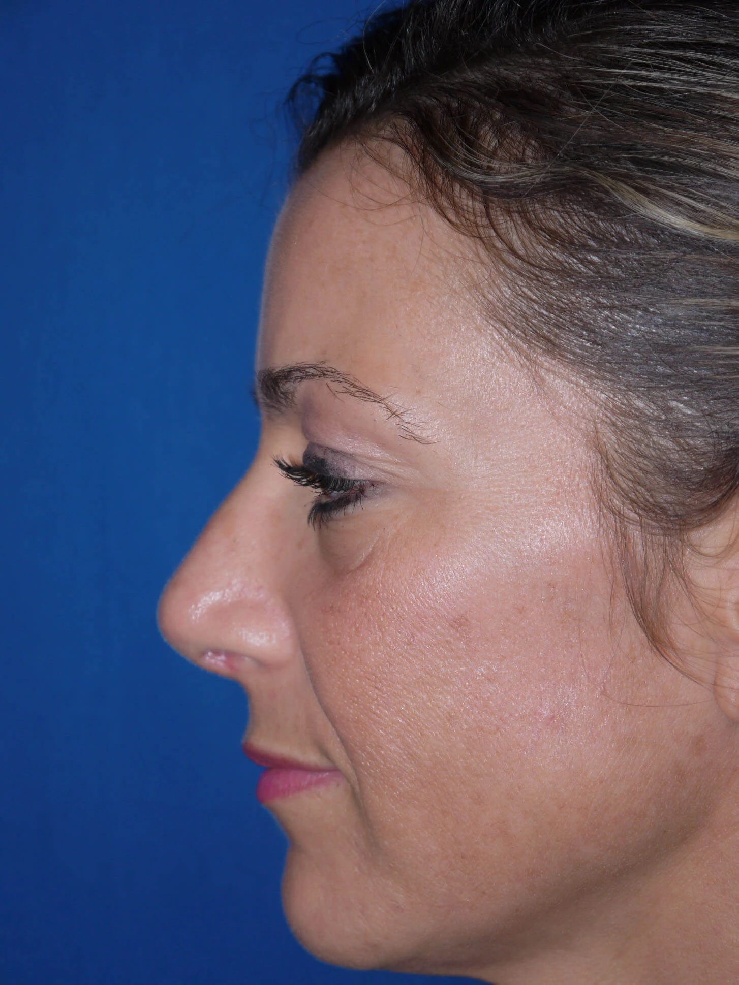 Case #18618 after left side