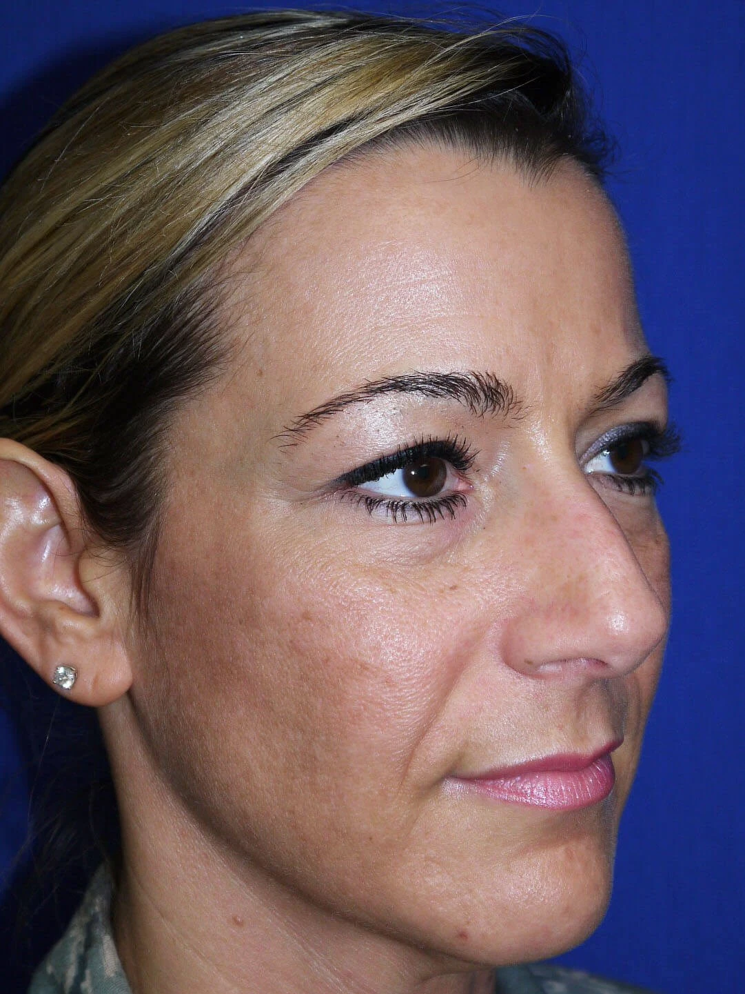 Case #18618 after right oblique