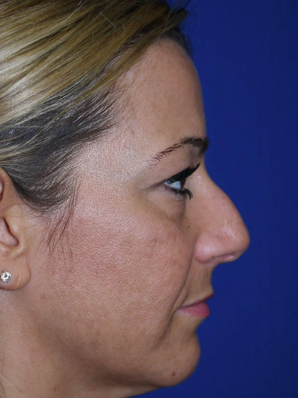 Case #18618 before right side