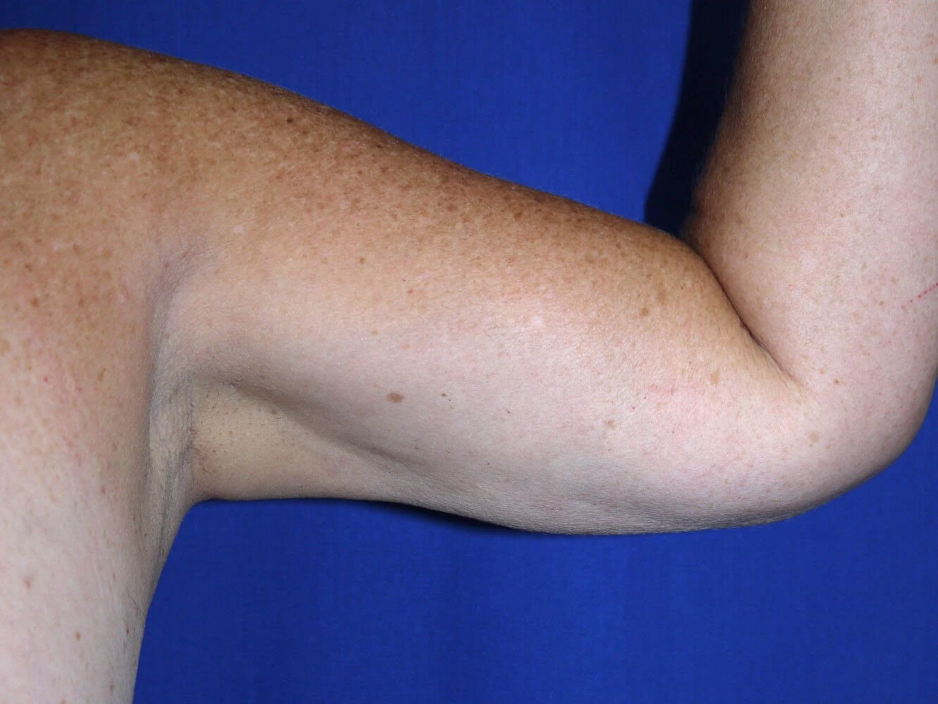 Case #18775 After front left